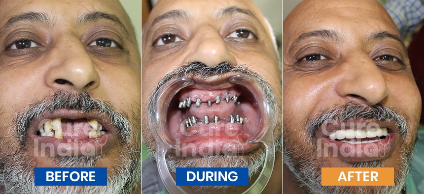 Dental implants before and after Case 5